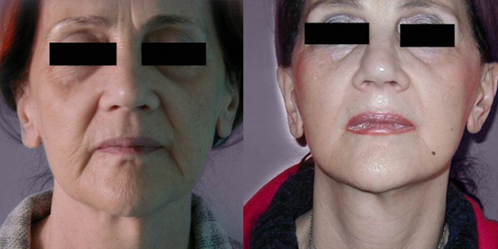 Facelifting – nakon 6 mjeseci